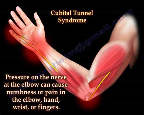 ulnar nerve entrapment